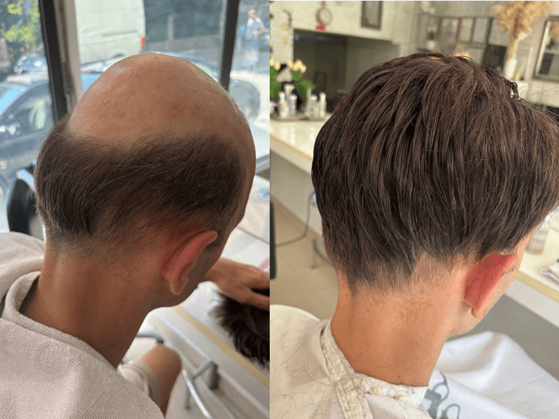 DMD rješenje za ćelavost